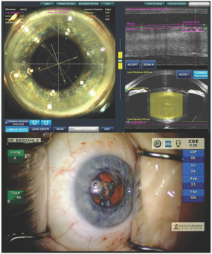 Femtosecond Laser-Assisted Cataract Surgery | Ento Key