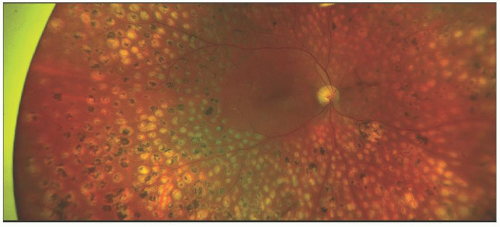 Panretinal Photocoagulation | Ento Key