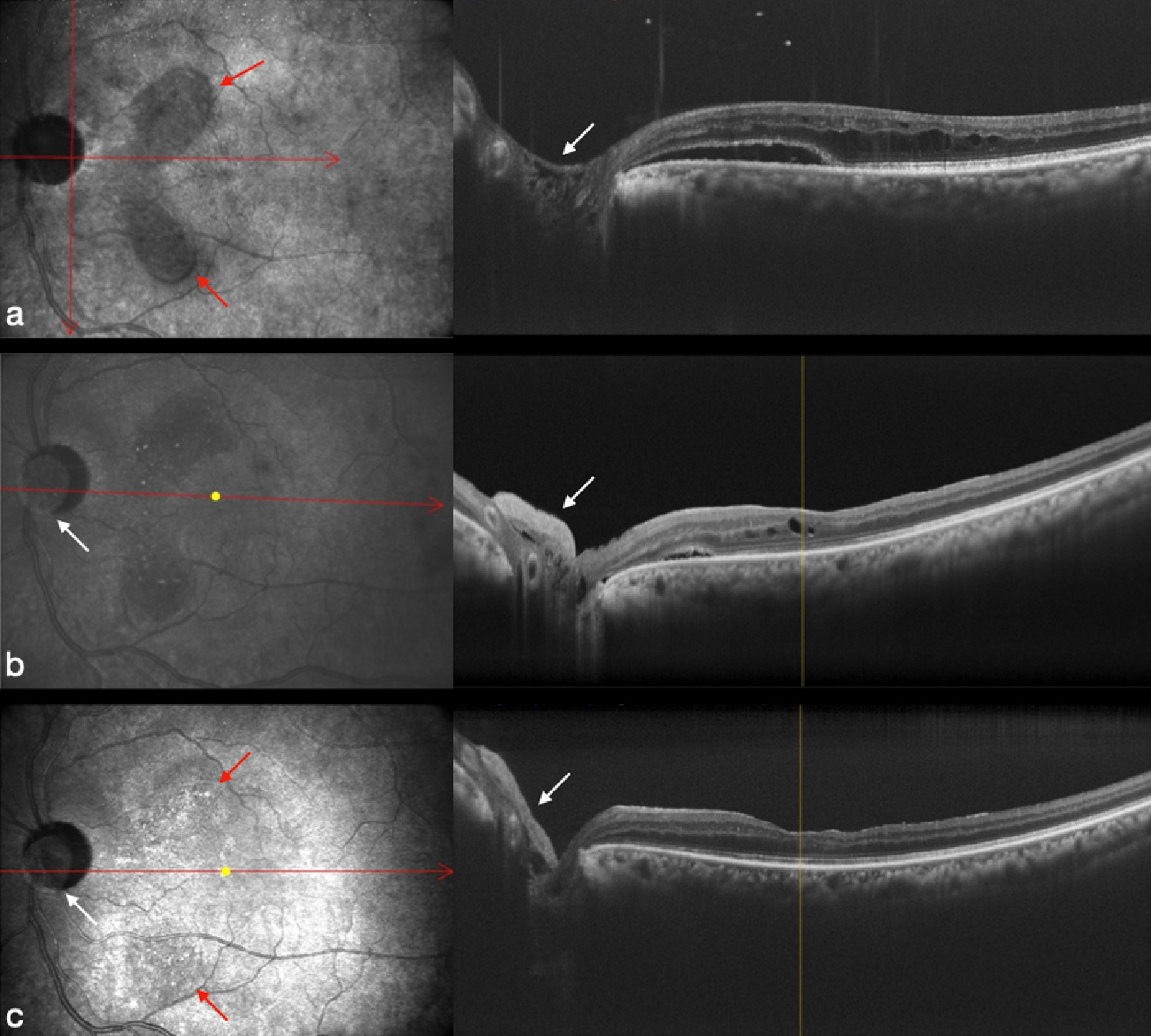 Optic Disk Pit Maculopathy Treatment Using A Human Amniotic Membrane ...