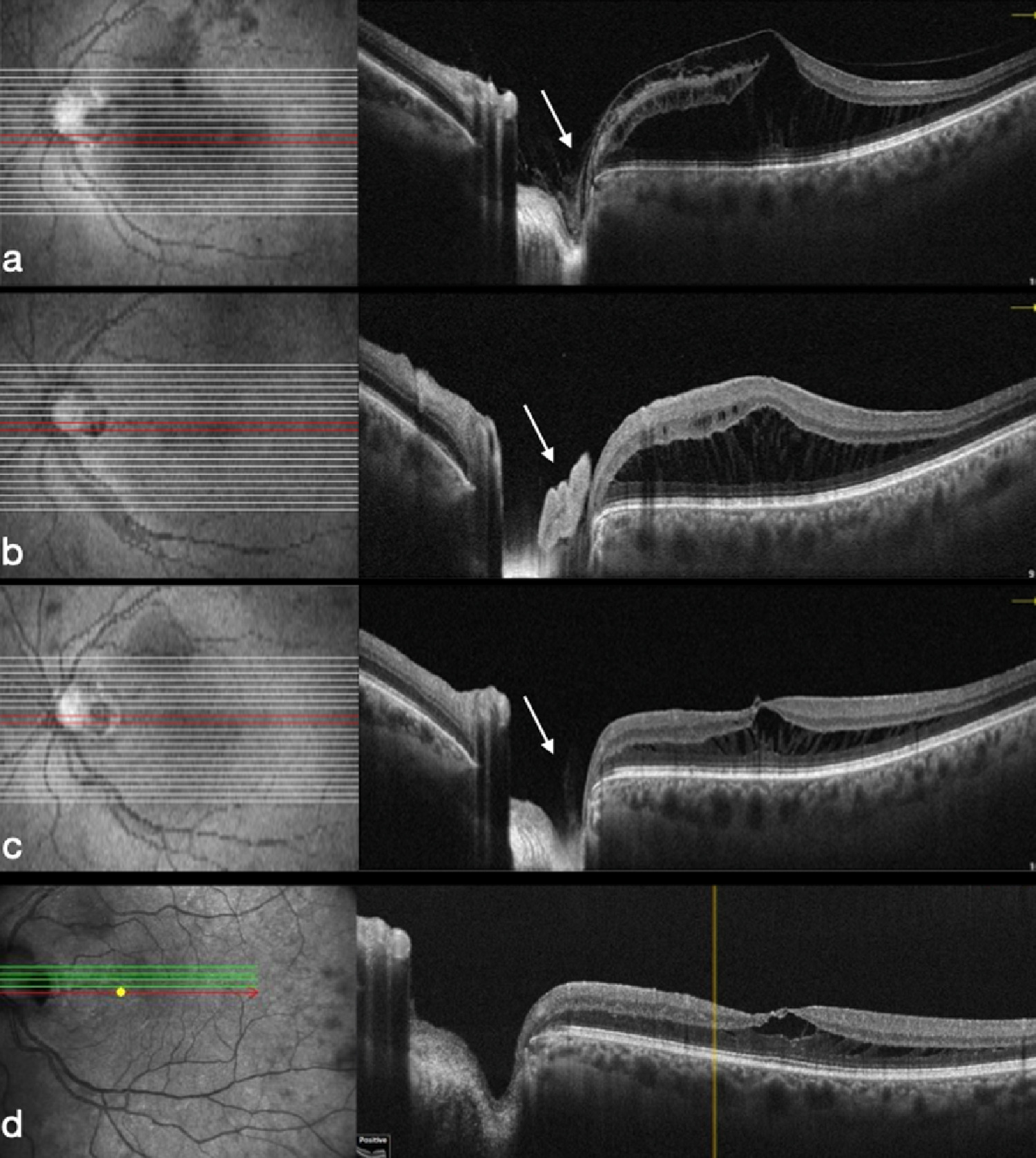 Optic Disk Pit Maculopathy Treatment Using A Human Amniotic Membrane ...