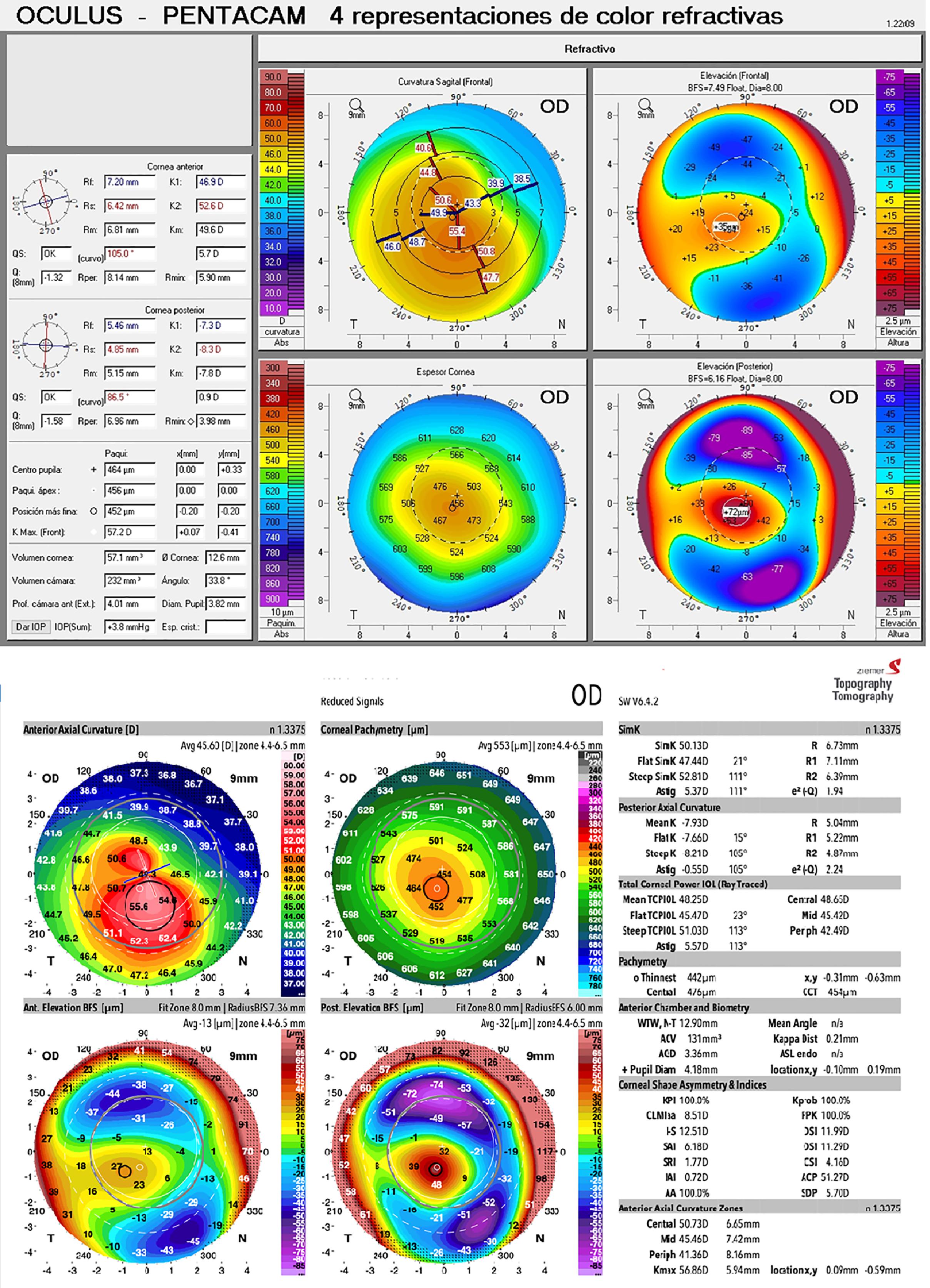 Keratoconus Definitions Ento Key
