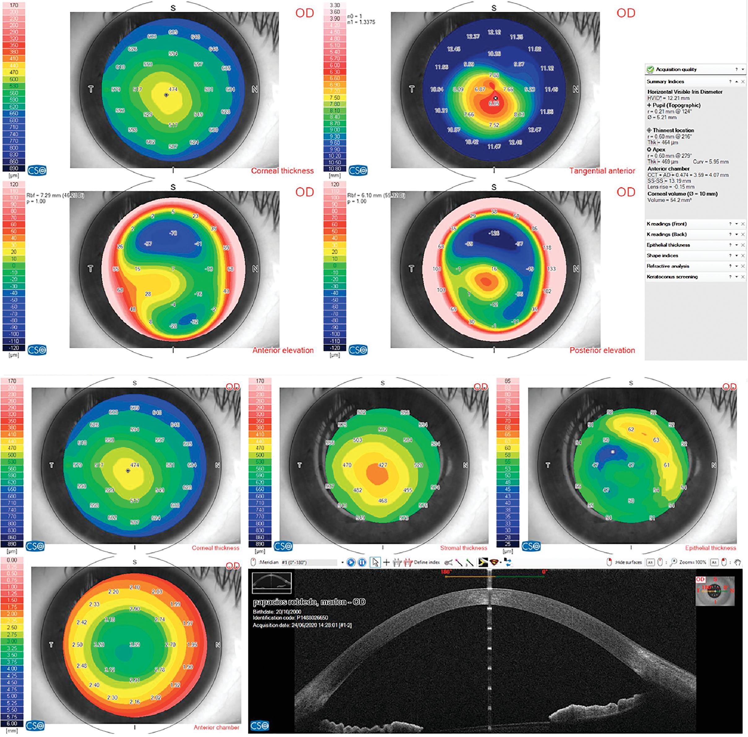 Keratoconus Definitions Ento Key
