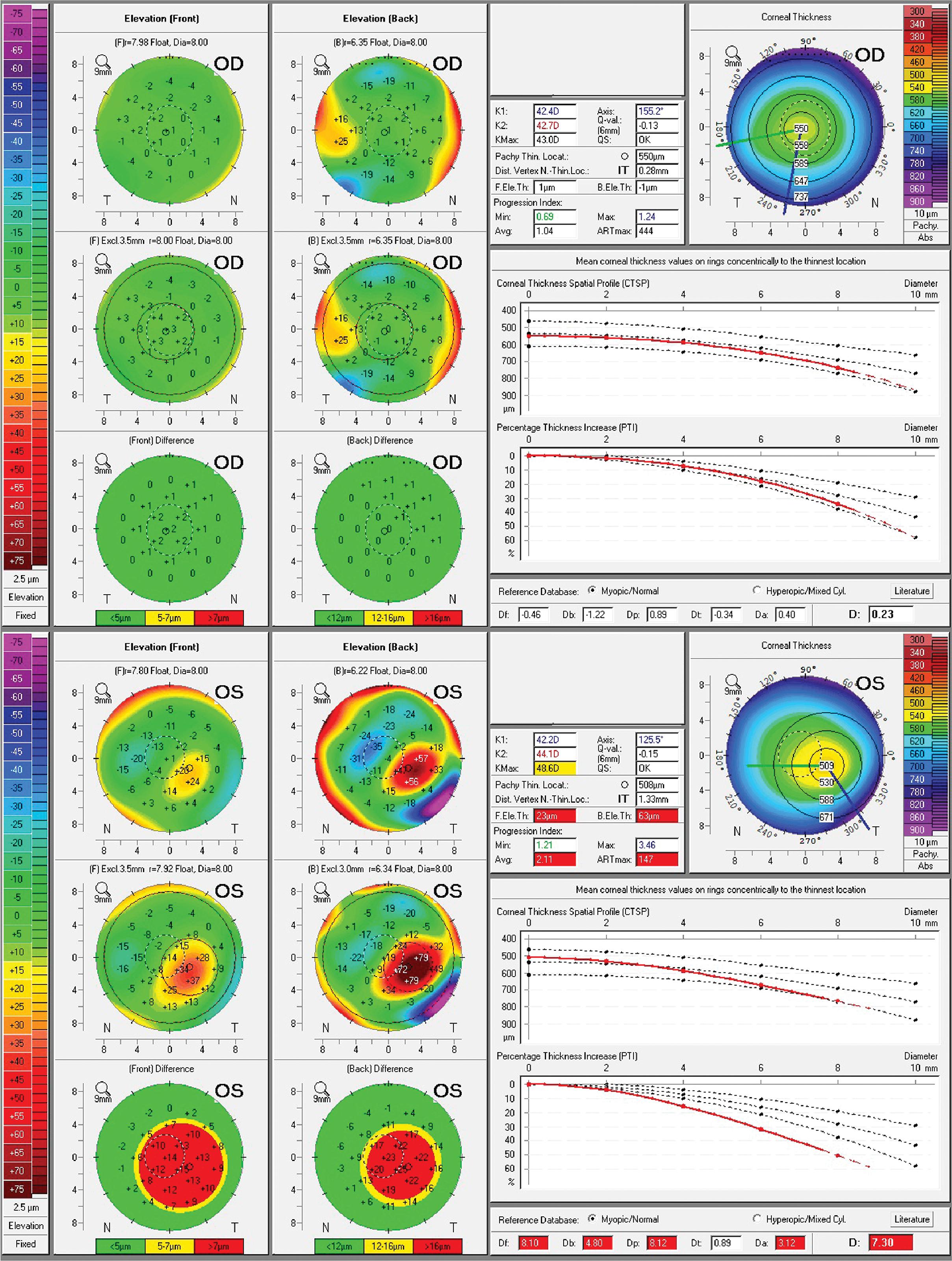 Keratoconus Definitions Ento Key