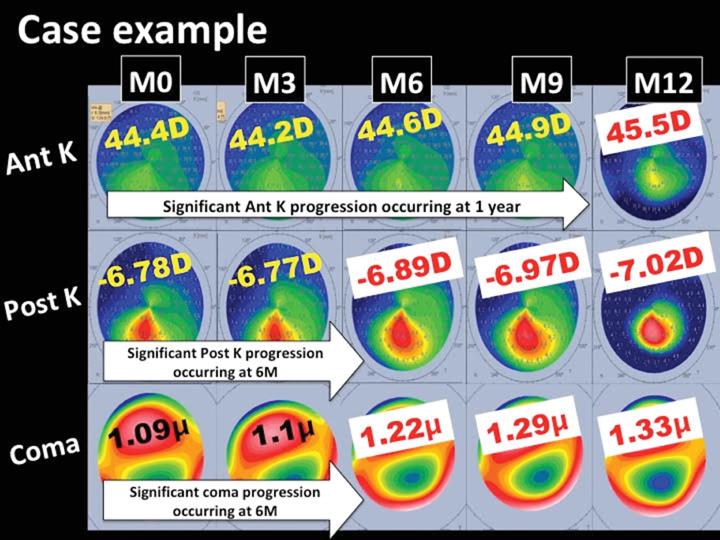 Clinical Course And Progression Of Keratoconus Ento Key
