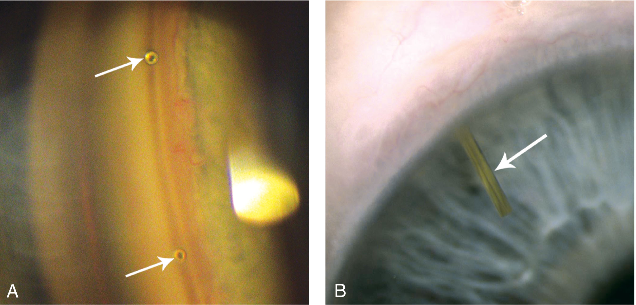 Glaucoma | Ento Key