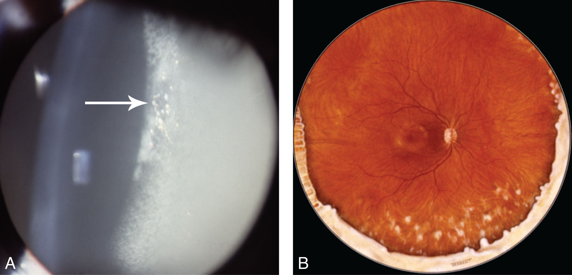 Uveitis | Ento Key