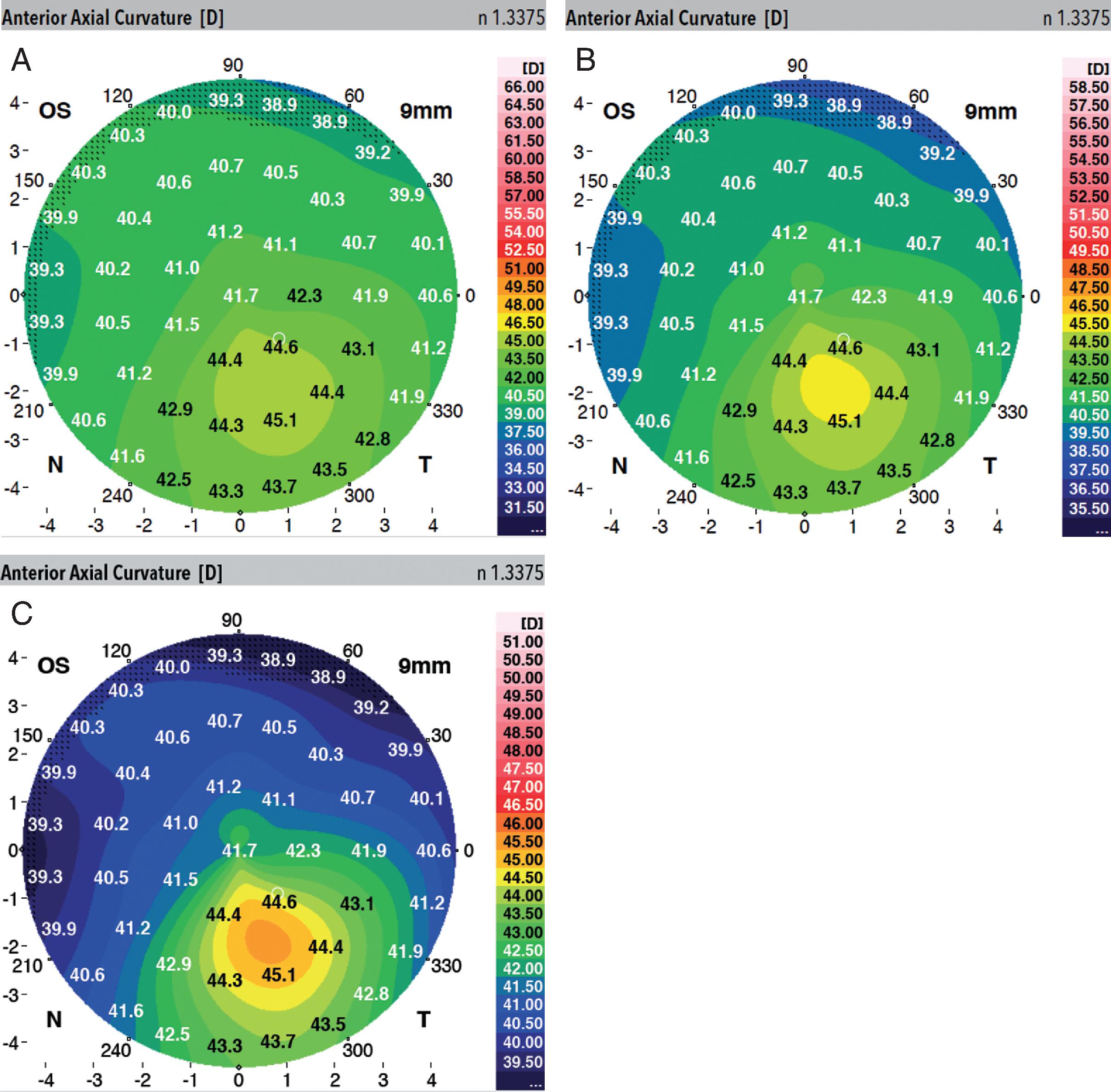 Corneal Topography In Keratoconus | Ento Key