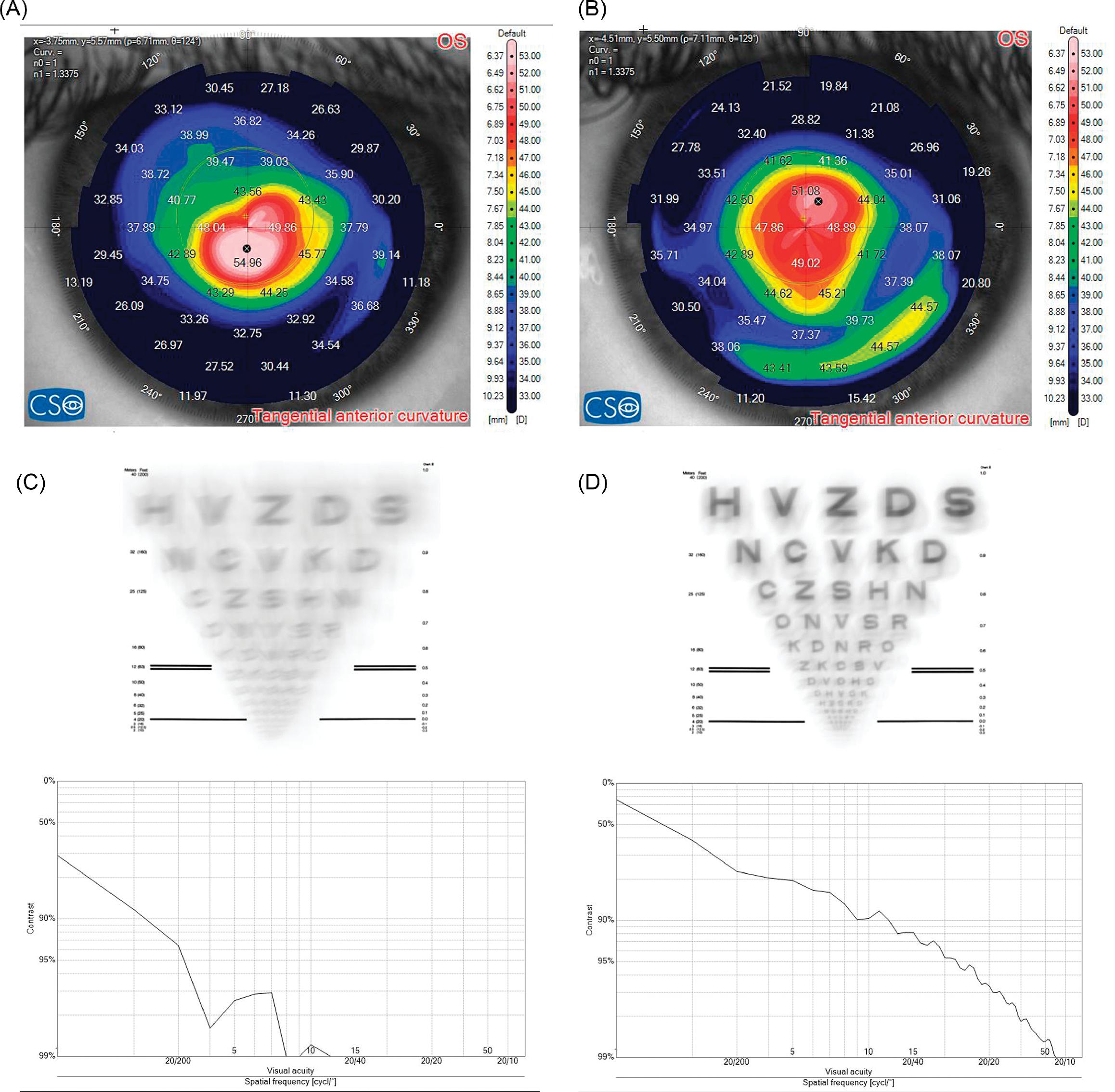 Corneal Laser Surgery For Keratoconus | Ento Key