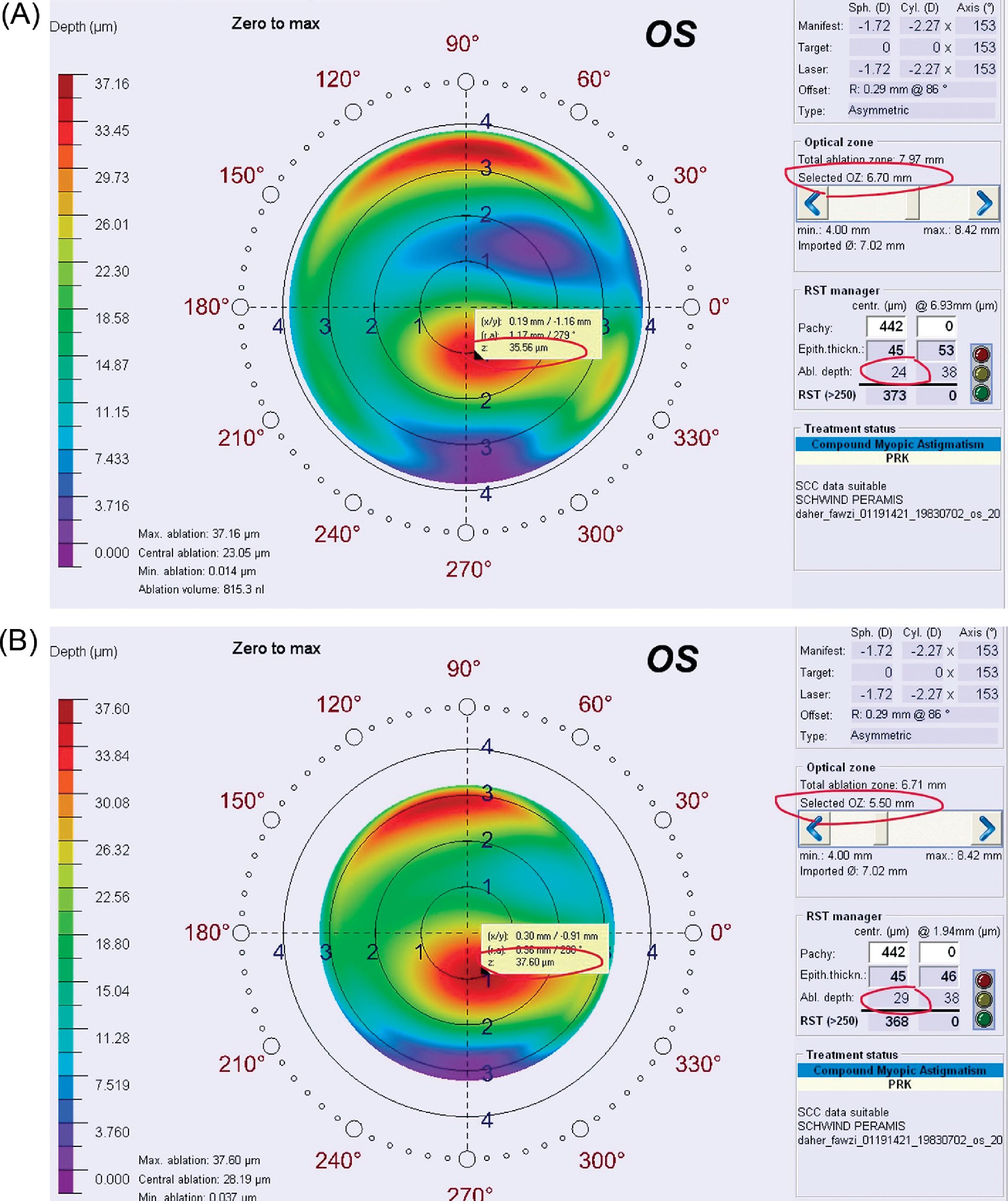 Corneal Laser Surgery For Keratoconus | Ento Key