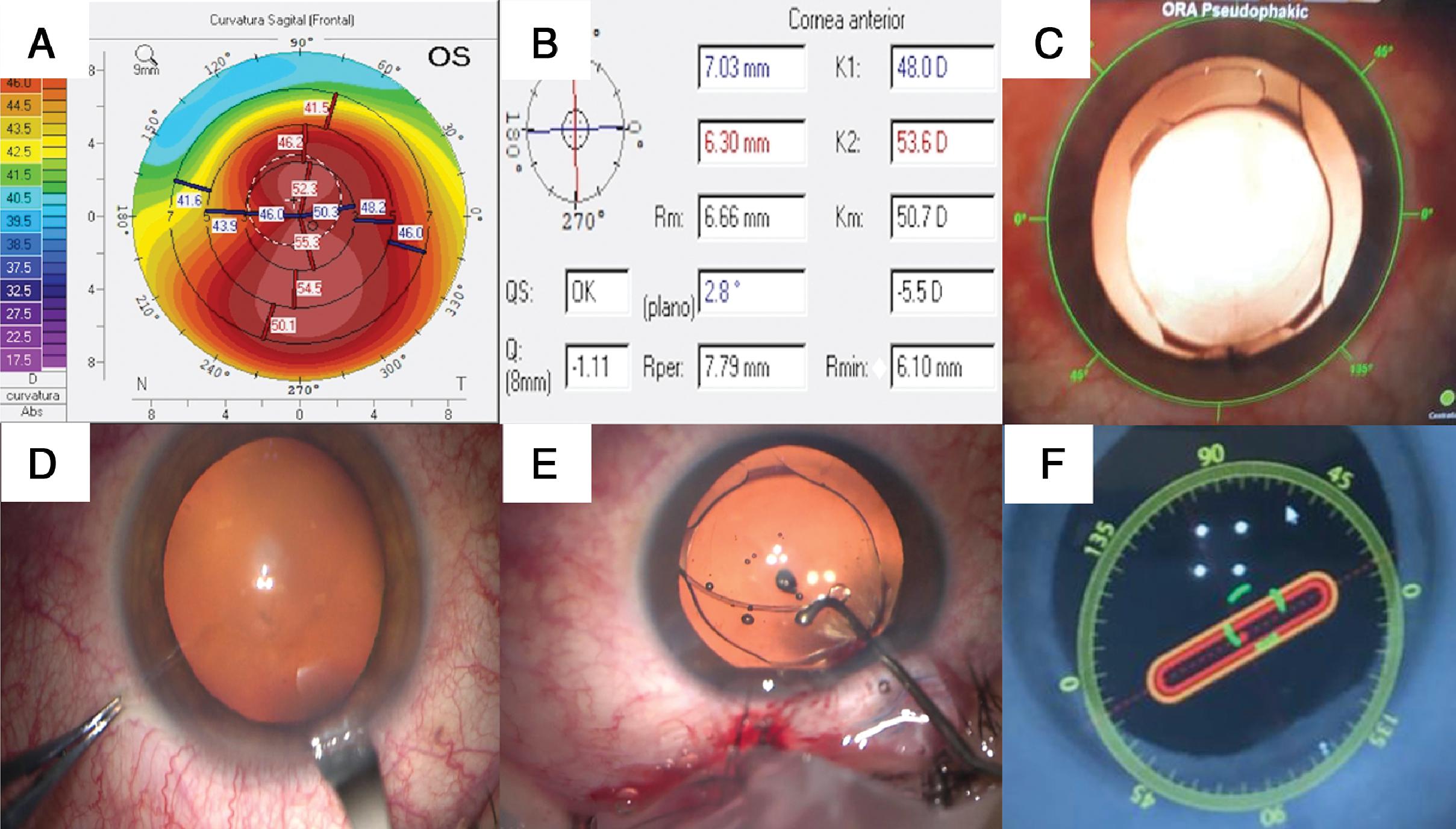 Cataract Surgery In The Keratoconus Patient | Ento Key