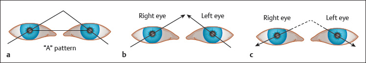 Strabismus (Squint) | Ento Key