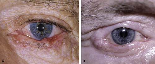 Squamous Cell Carcinoma | Ento Key