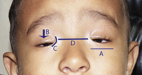 Blepharophimosis Syndrome | Ento Key