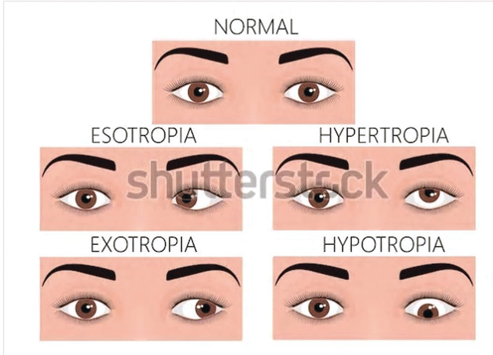 Neuro‐ophthalmology | Ento Key