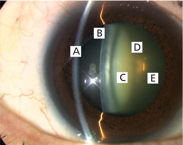 Cataracts | Ento Key