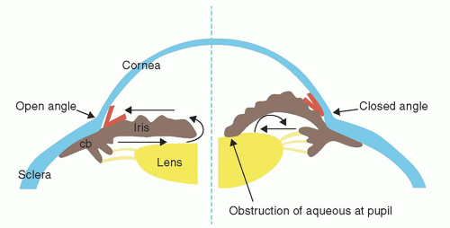 Angle Closure Glaucoma | Ento Key